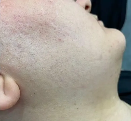 Gesicht nach Laser-Haarentfernung in München - HelloHairless Ergebnis