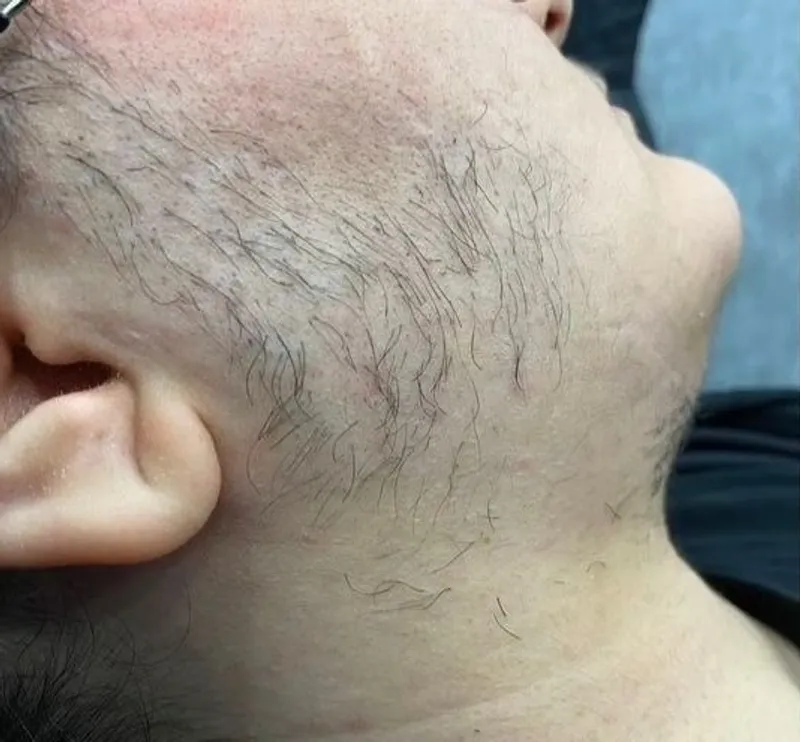 Vorher: Vorher-Nachher Ergebnis der dauerhaften Haarentfernung - Beispiel 2