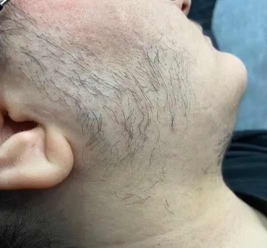 Gesicht vor Laser-Haarentfernung in München - HelloHairless Vorher-Bild