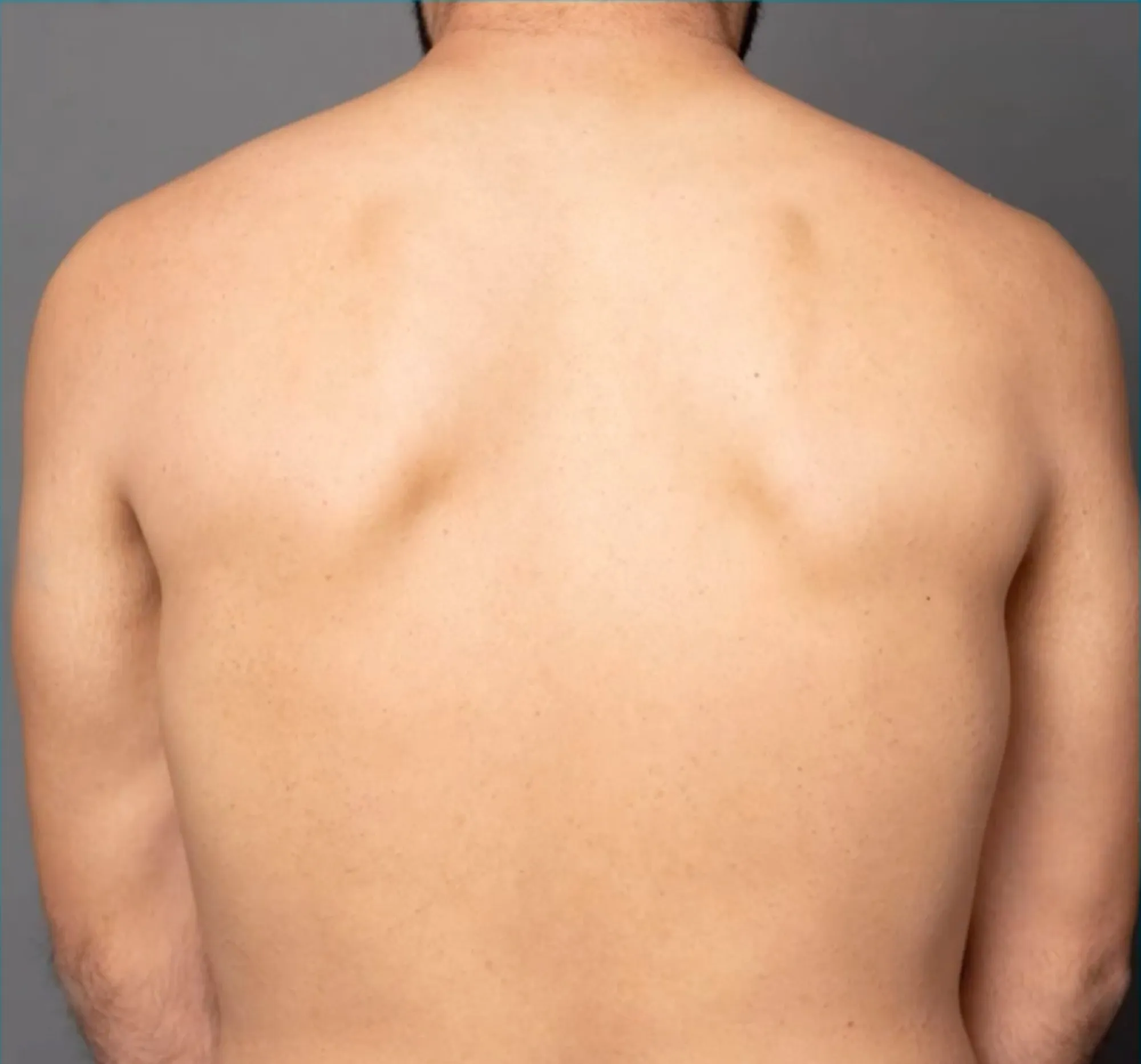 Rücken nach Laser-Haarentfernung in München - HelloHairless Ergebnis