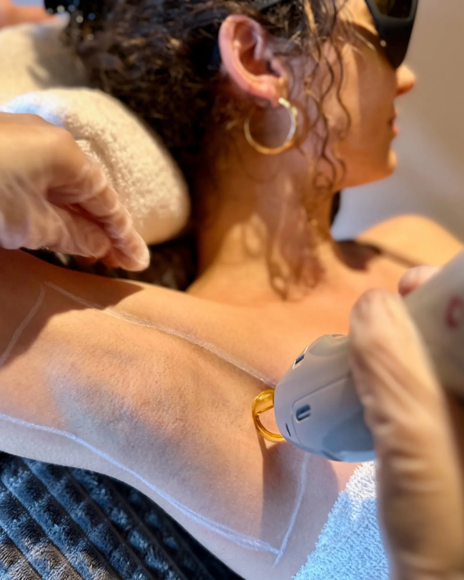 Professionelle Achseln Laser-Haarentfernung Behandlung im HelloHairless Studio München