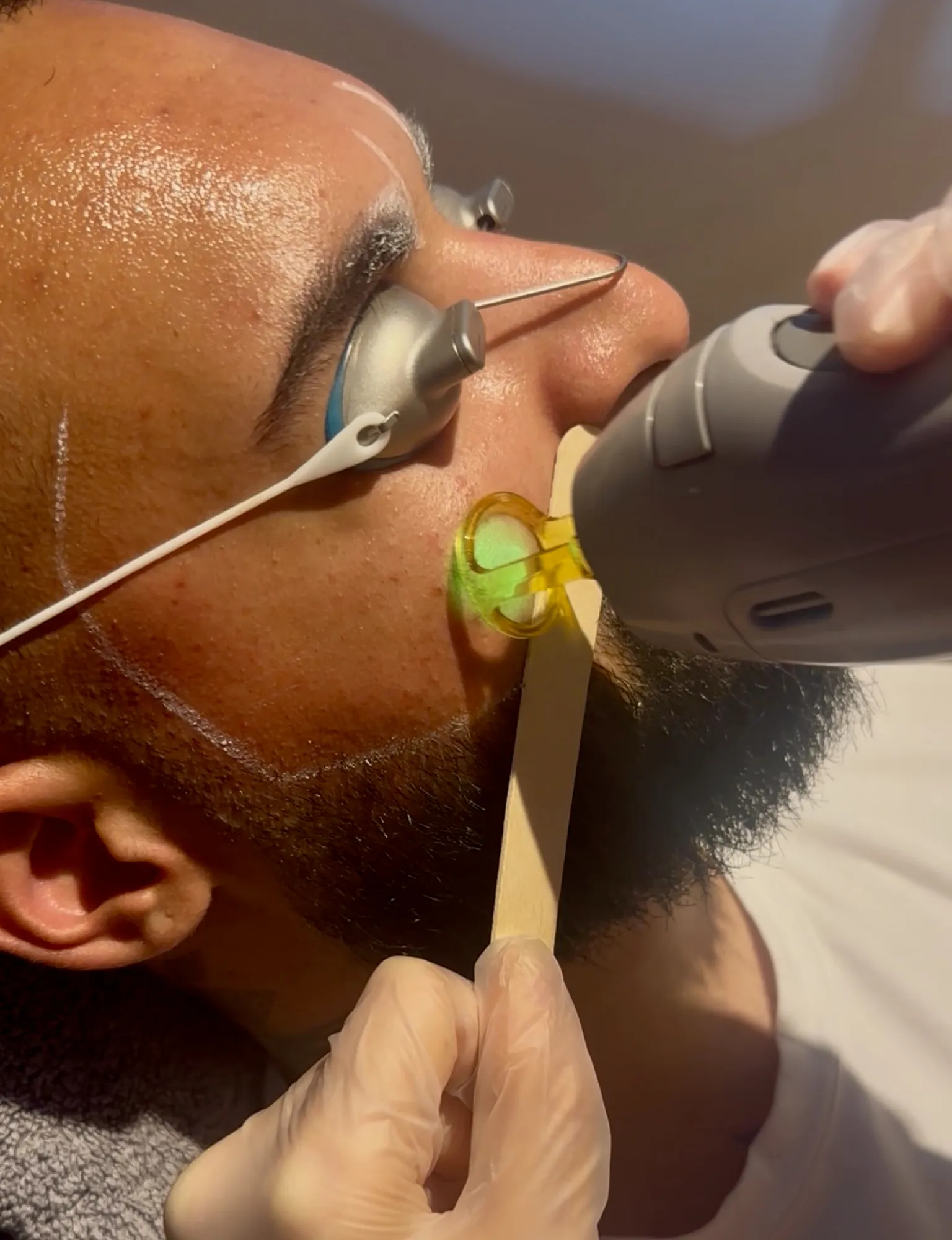 Professionelle Bart Laser-Haarentfernung Behandlung im HelloHairless Studio München