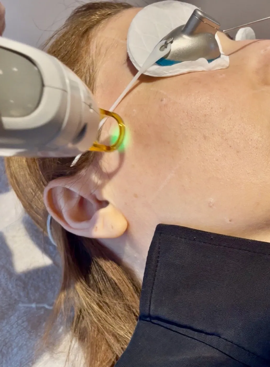 Präzises Damenbart lasern an der Oberlippe mit dem Candela GentleMax Pro im HelloHairless Studio München