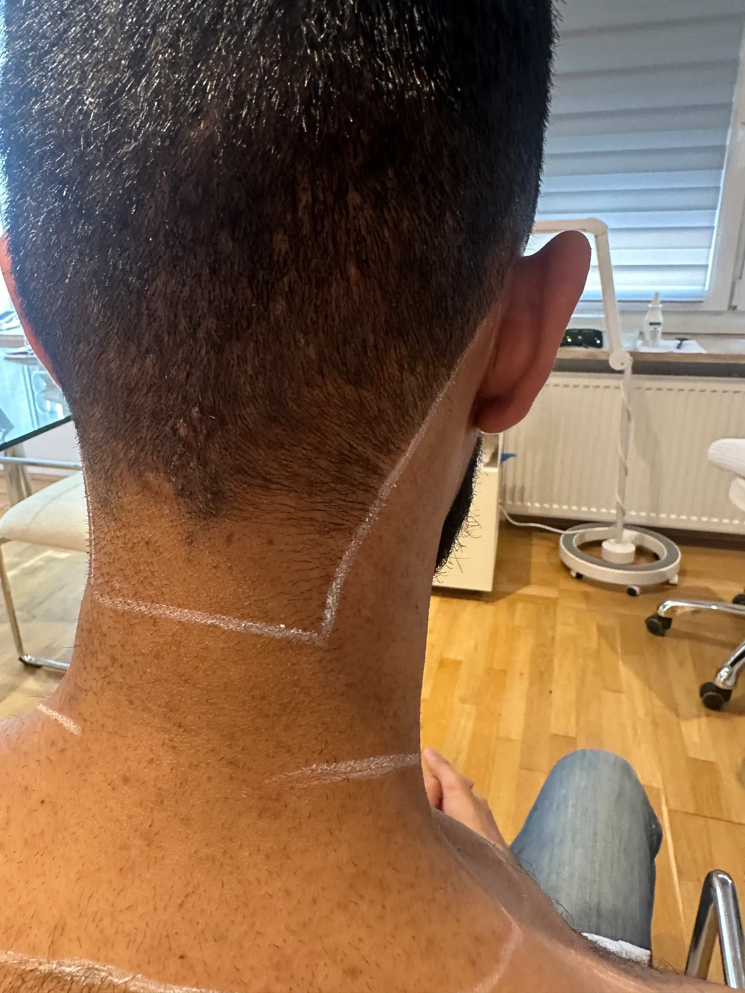 Professionelle Nacken Laser-Haarentfernung Behandlung im HelloHairless Studio München