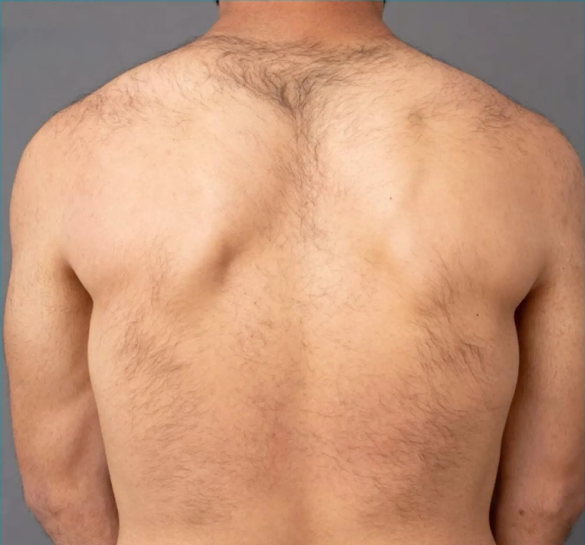 Rücken vor Laser-Haarentfernung in München - HelloHairless Vorher-Bild